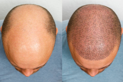 FUE (Follicular Unit Extraction)
